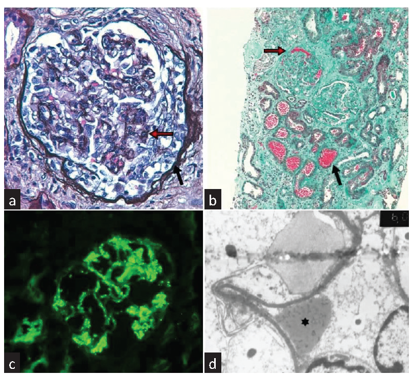 Oral Anticoagulant-Related Nephropathy: A New Cause for an Old Entity