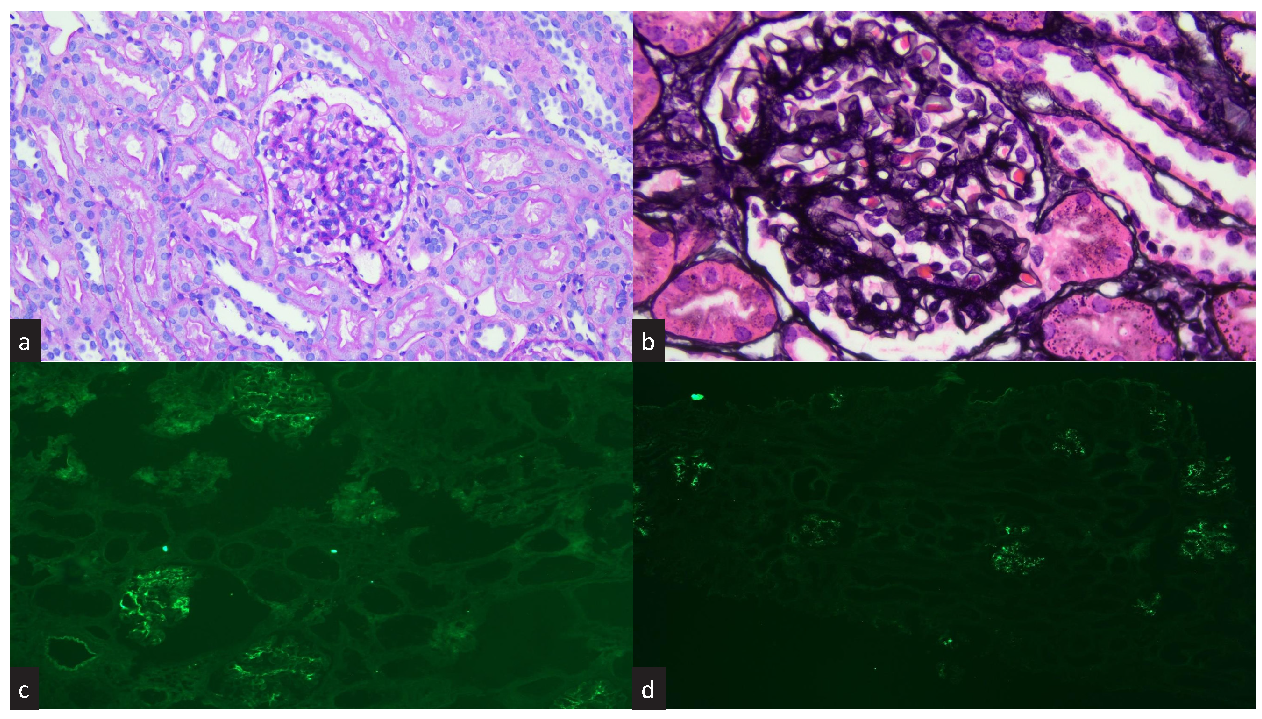 Mesangial C1q Deposition in IgA Nephropathy: Does the Classical Complement Pathway Play an Independent Role?