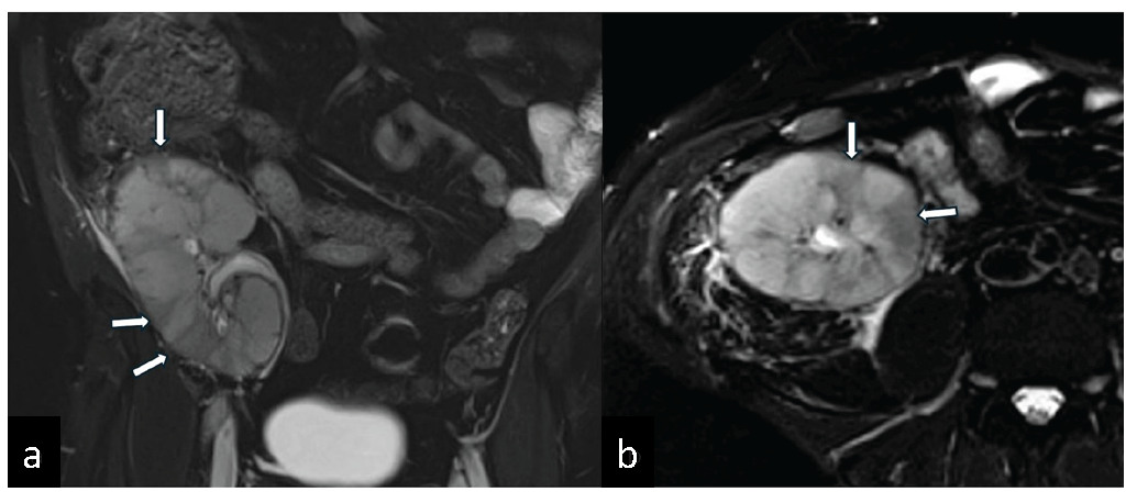 Factor V Leiden Heterozygous Mutation and Hyperhomocysteinemia Presenting with Vascular Rejection and Renal Allograft Infarction