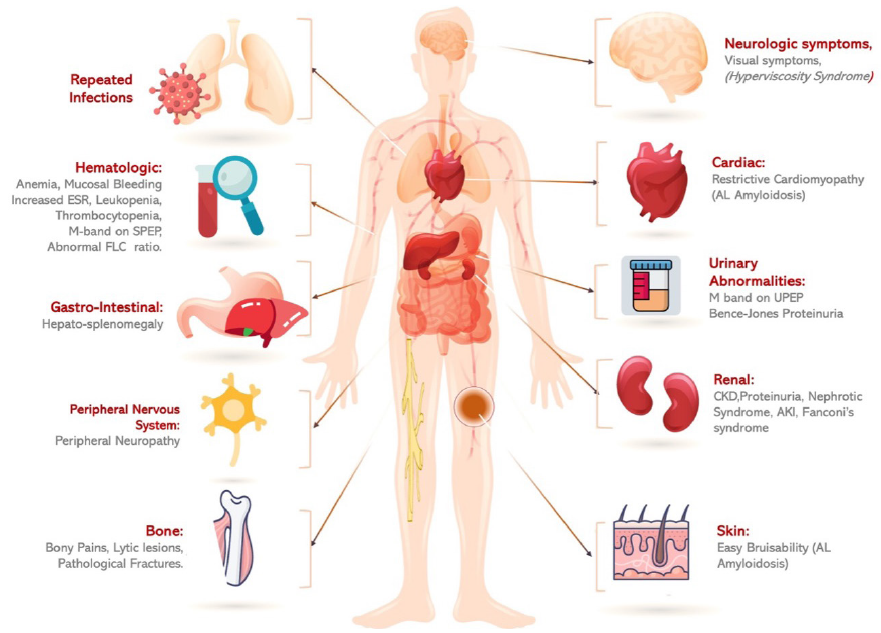 Recent Updates in the Diagnosis and Management of Kidney Diseases in Multiple Myeloma