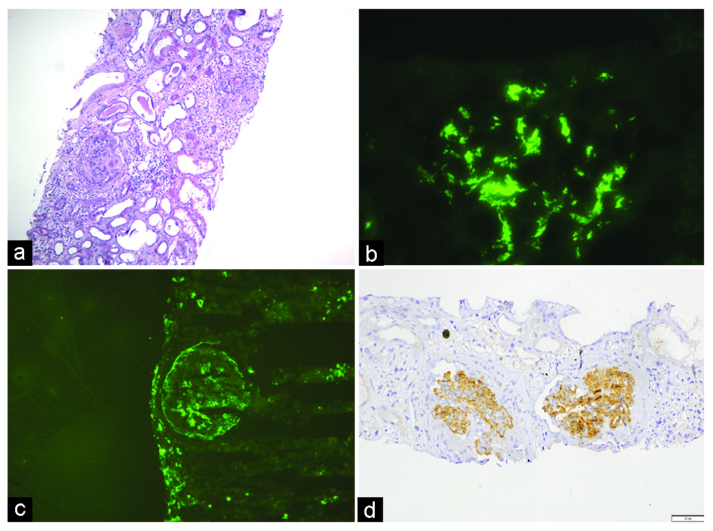 Fibrillary Glomerulonephritis with Prevalent IgA Deposition Associated with Psoriasis