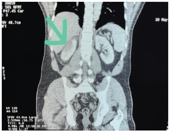 A Case of Acute Renal Infarct Secondary to Protein S Deficiency