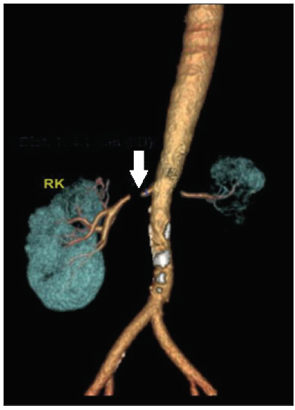 Radiation-Induced Renal Artery Stenosis