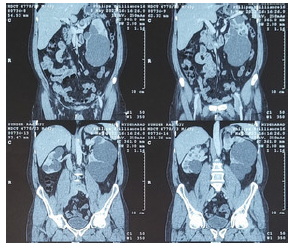 Anti-Phospholipase A2 Receptor Antibody Testing to the Rescue