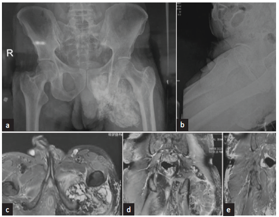 GALNT3 Mutation in Hyperphosphatemic Familial Tumoral Calcinosis – Novel Etiology of Secondary Amyloidosis