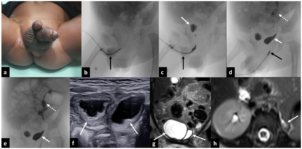 Diphallia with Duplicated Urethra and Urinary Bladder: A Rare Congenital Genitourinary Tract Anomaly