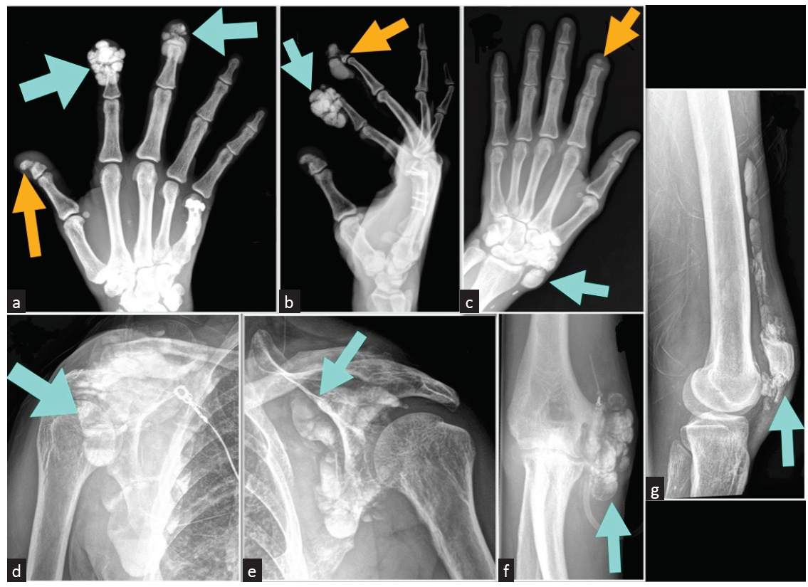 Extensive Tumoral Calcinosis and Acral Osteolysis