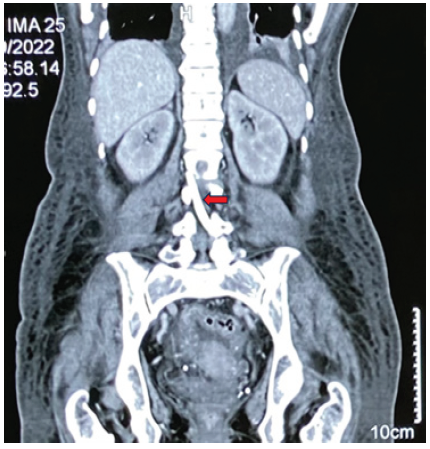 Tunneled Hemodialysis Catheter Making its Way into the Spinal Canal: An Unusual Complication