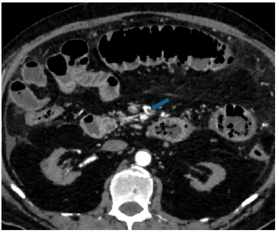 A Rare Case of Peritonitis in a Patient on CAPD for Nine Years