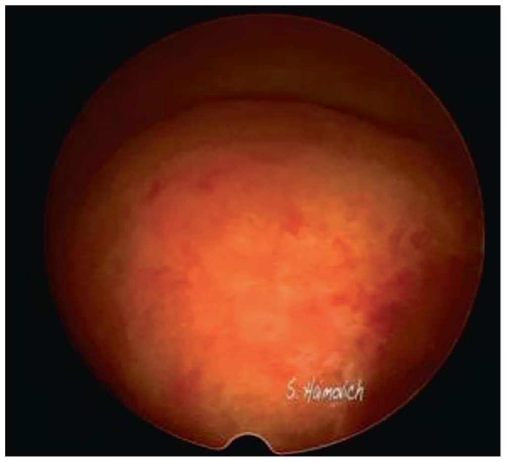Efficacy of Hysteroscopy in Improving Fertility Outcomes in Assisted Reproductive Techniques