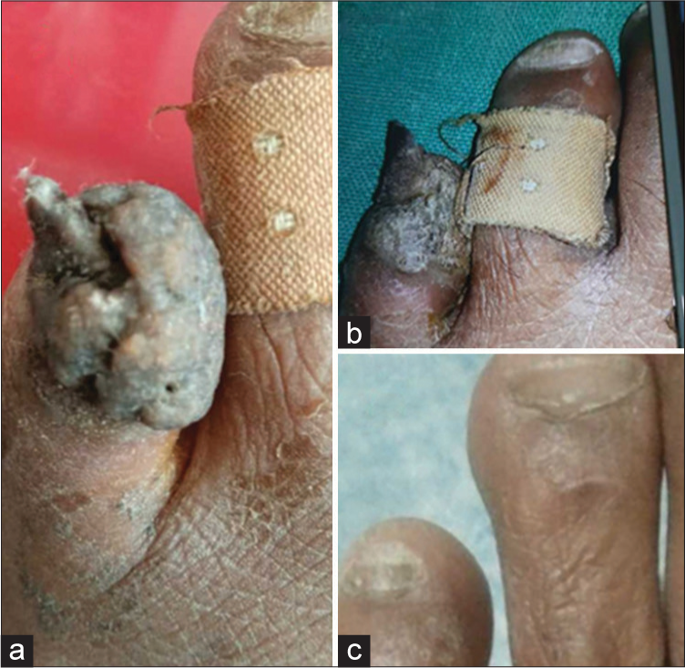 Therapeutic pearl: A simple thermo-sclero-keratolytic therapy for recalcitrant periungual viral warts