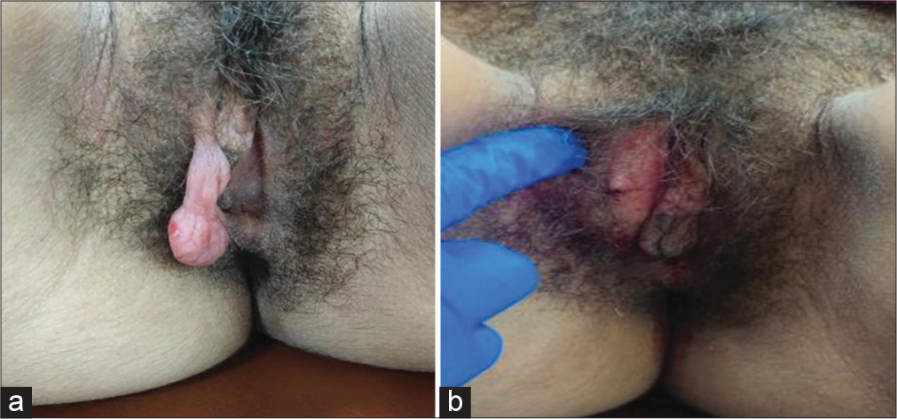 A rare case of superficial vulvar angiomyxoma