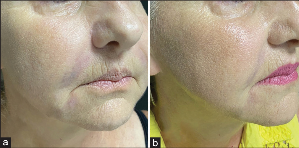 Spontaneous and induced degradation of dermal fillers: A review