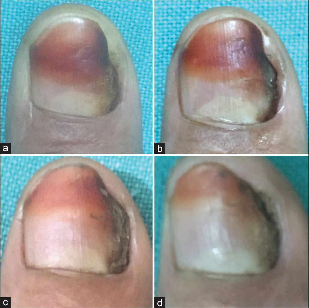 Therapeutic pearl: chemical sealing of the nail plate and its gutter for treating lateral nail plate dystrophy of the fingernail