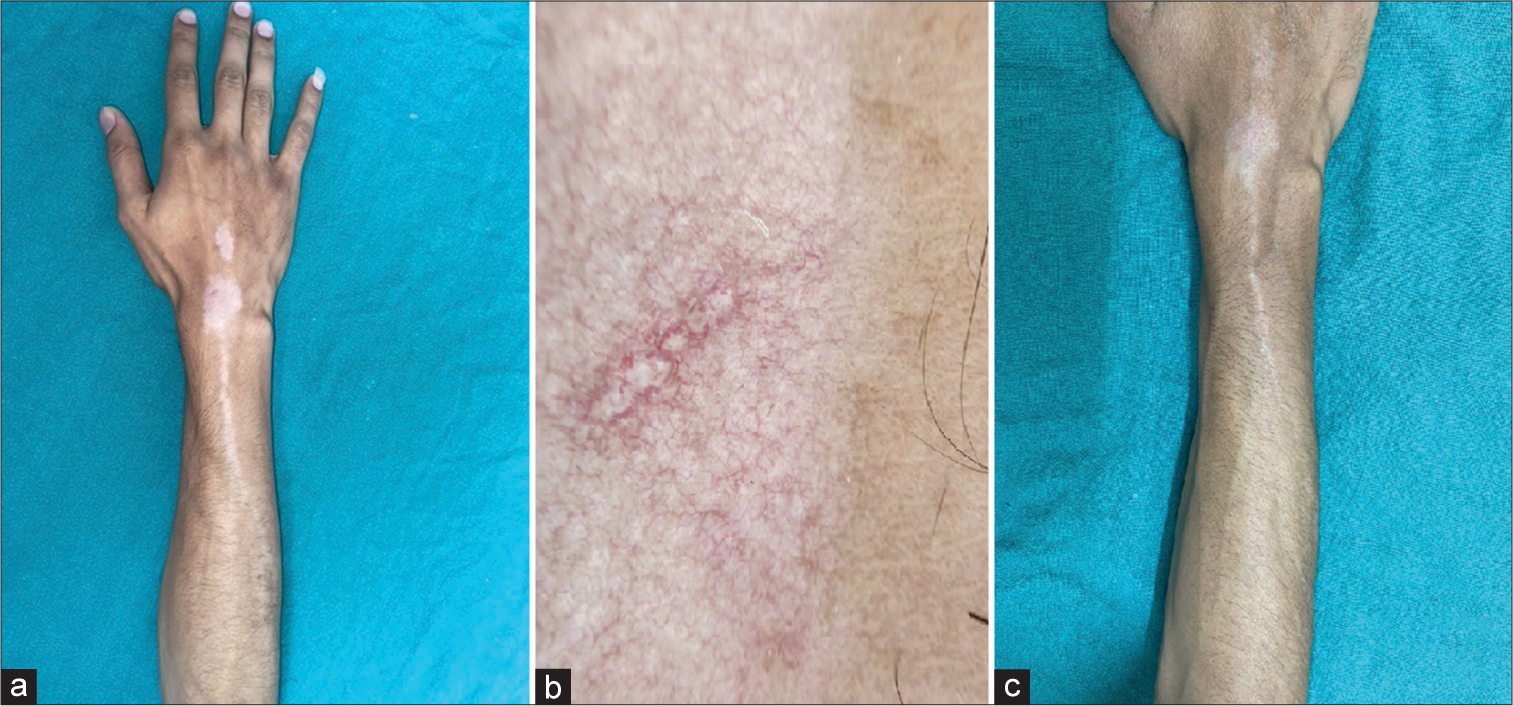 Linear supravenous hypopigmentation secondary to intralesional corticosteroid injection