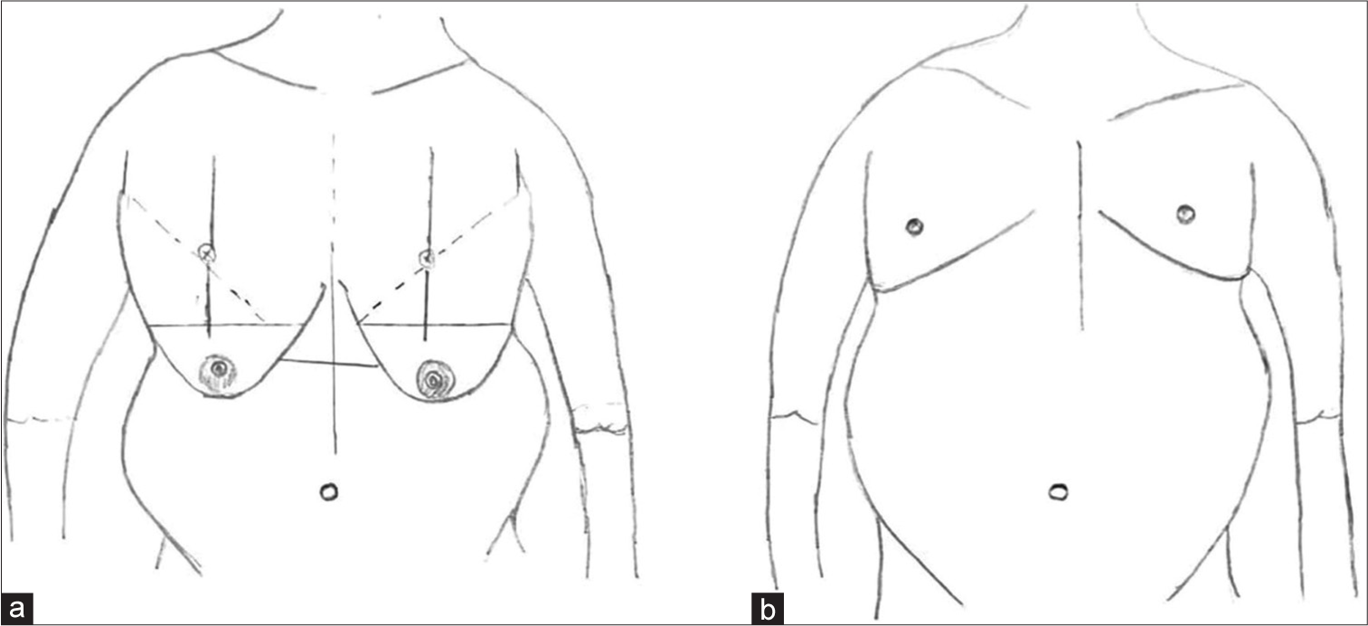 Should high BMI of transmasculine patients prevent them from masculinizing their chest walls?