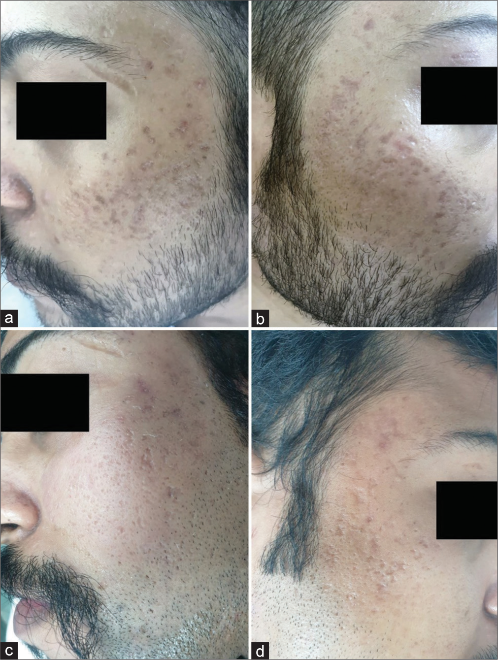 Microneedling with autologous platelet-rich plasma versus topical insulin for treating postacne scars: A split-face comparison