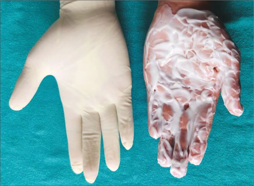 Hyperocclusive technique for topical anesthesia for injecting botulinum toxin in palmar hyperhidrosis