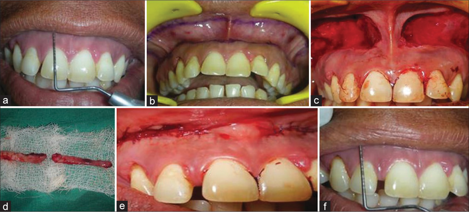 Comparative evaluation of conventional versus modified lip repositioning surgery for gummy smile: A two-year follow-up study