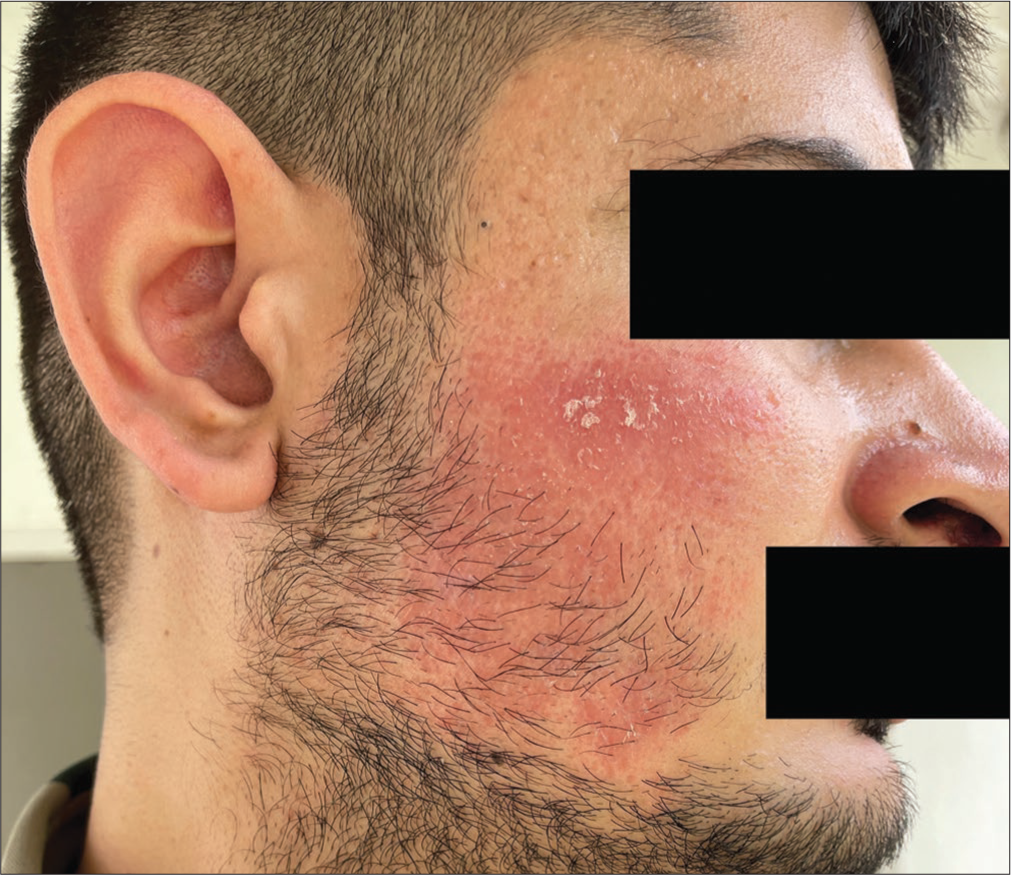 A case of granulomatous dermatitis following dermaroller therapy for acne scars treated with methotrexate: A difficult-to-treat condition