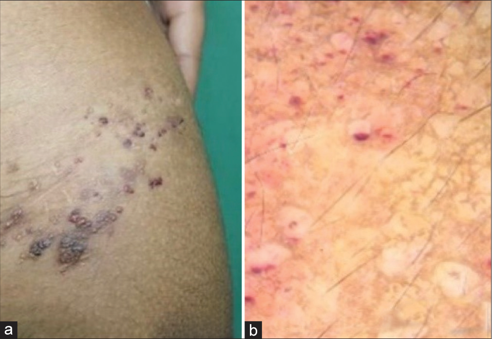 Recurrent lymphangioma circumscriptum: Treated with microneedling radiofrequency and topical sirolimus