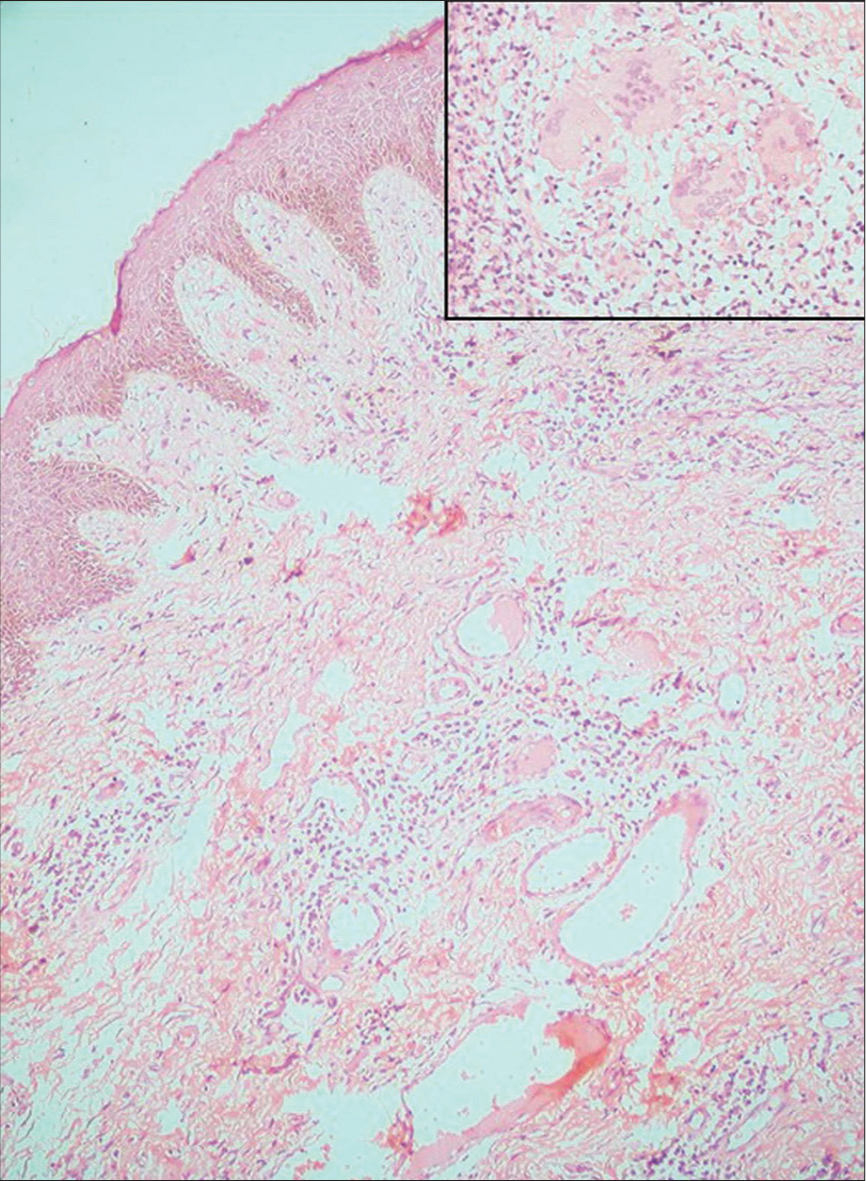 Platelet-rich fibrin therapy as an adjuvant treatment in the management of metastatic Crohn’s disease: A case series