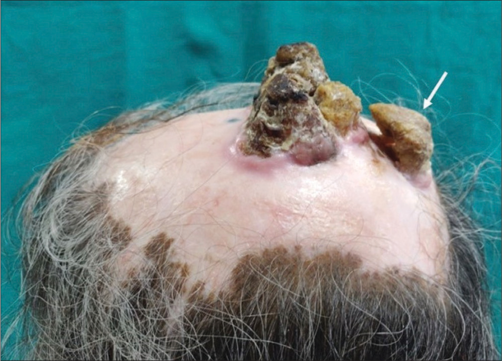 Cutaneous horn with underlying squamous cell carcinoma complicating discoid lupus erythematosus of scalp: A hitherto unreported complication