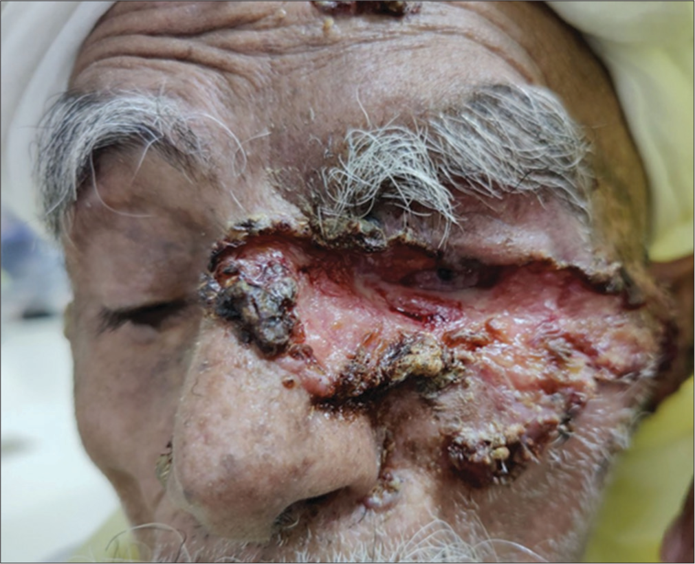 Giant neglected unresectable ulcerated basal cell carcinoma of face: Radiotherapy at rescue