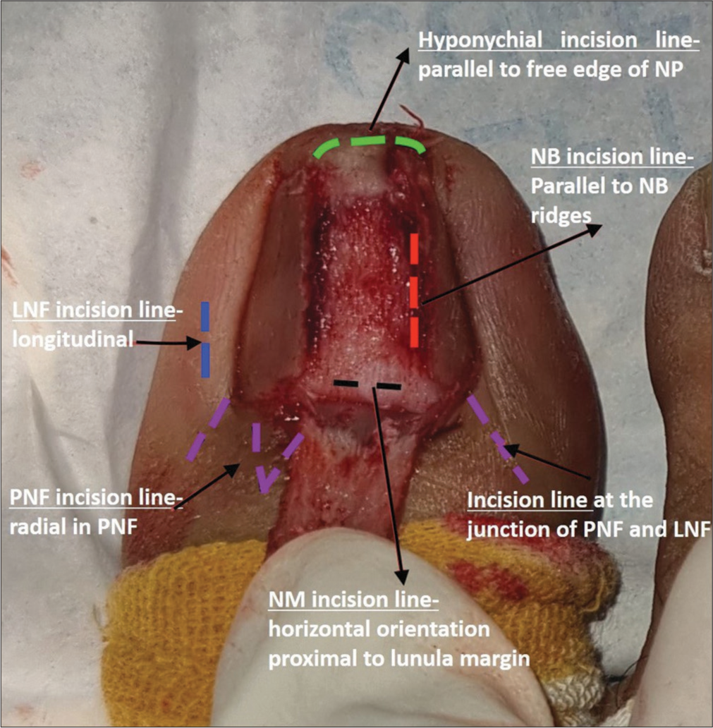 Nail unit incision lines: A tool to minimize nail unit scarring