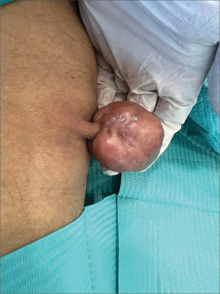 Pedunculated superficial angiomyxoma of the thigh mimicking molluscum pendulum