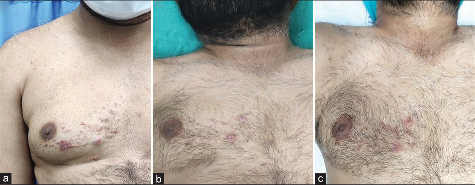 Use of monopolar and bipolar radiofrequency probes for treatment of cutaneous leiomyoma