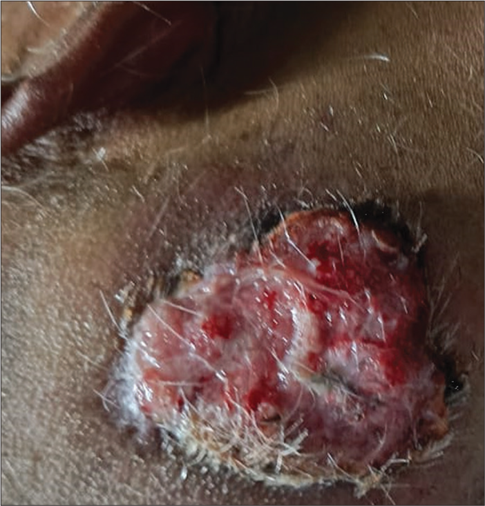 Malignant proliferating trichilemmal tumor in male: A rare case entity with diagnostic dilemma