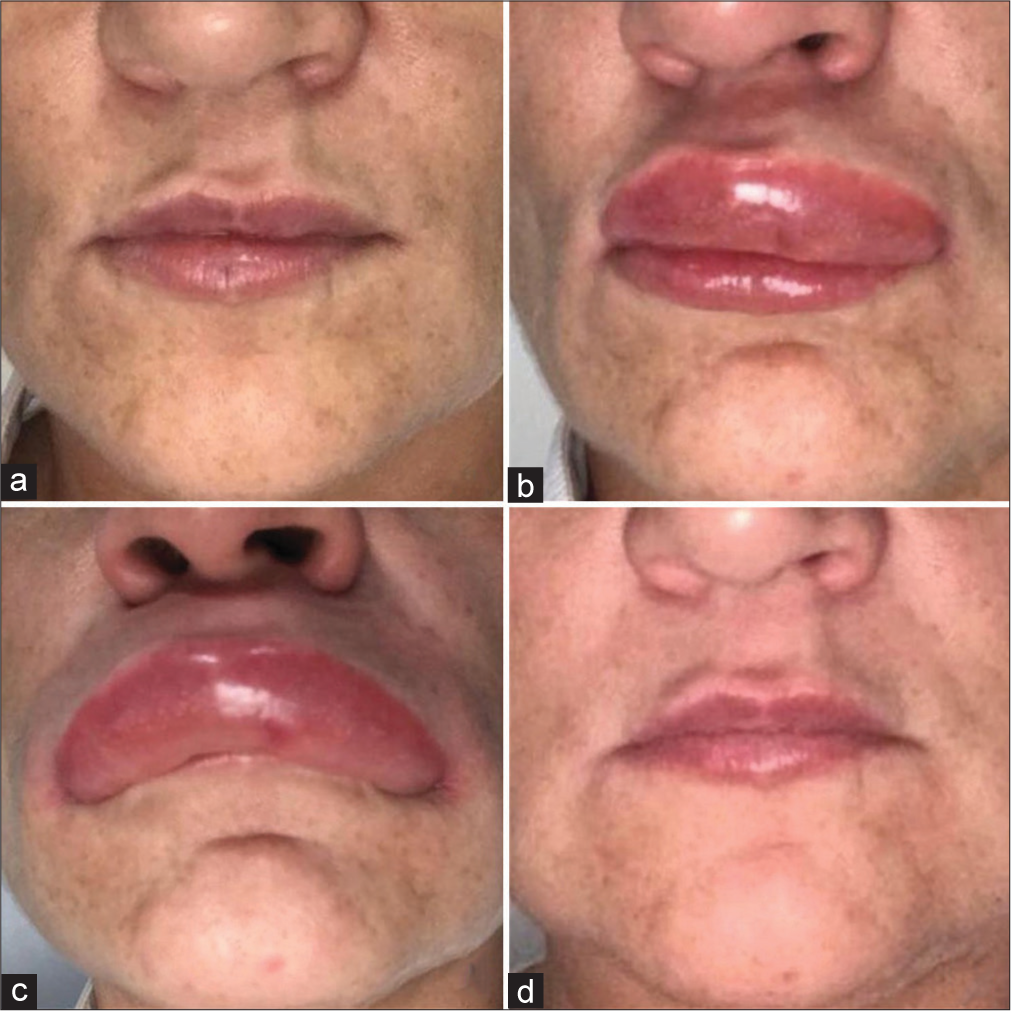 Anaphylactic reaction to hyaluronidase use for a complication of lip augmentation with hyaluronic acid