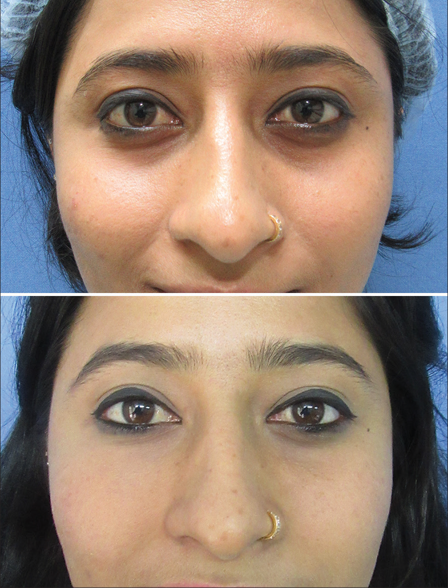 Combined supraperiosteal microfat grafting and intradermal nanofat for the treatment of periorbital melanosis (dark circles)