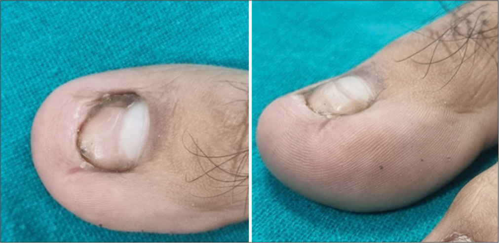 Commentary on “Nail surgery: General principles, fundamental techniques, and practical applications”