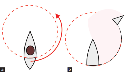 Skin-saving modification of the rotation flap