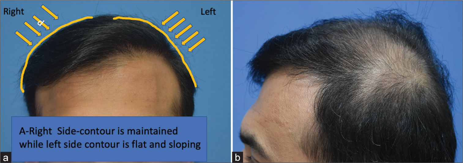 Esthetic importance of parietal eminence area (posterior parietal triangle), an essential island of scalp requiring hair restoration