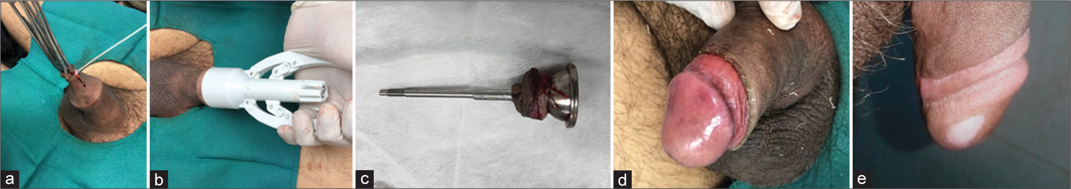 Disposable circumcision suture device: A potential bedside tool for circumcision – A series of 18 cases