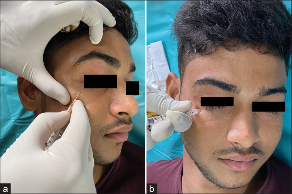 Use of syringe for atraumatic removal of milia