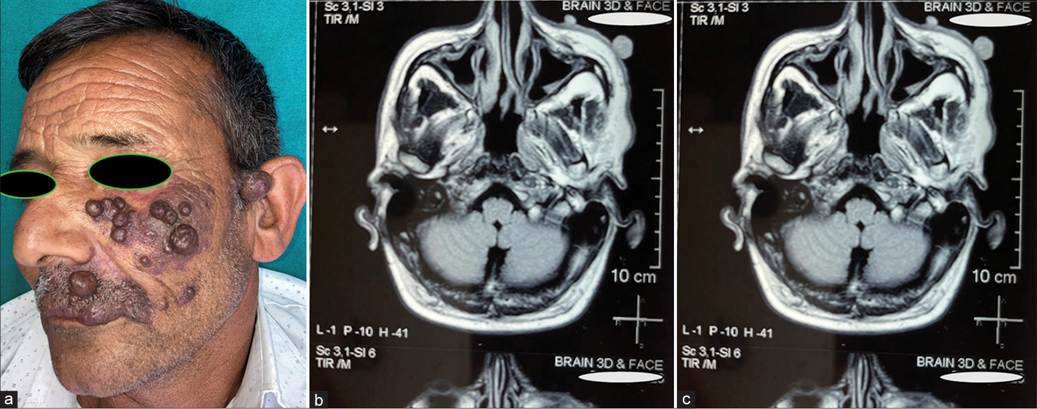 Optimizing management of secondary changes in port-wine stains: Navigating resource constraints with staged debulking surgery and radio frequency ablation