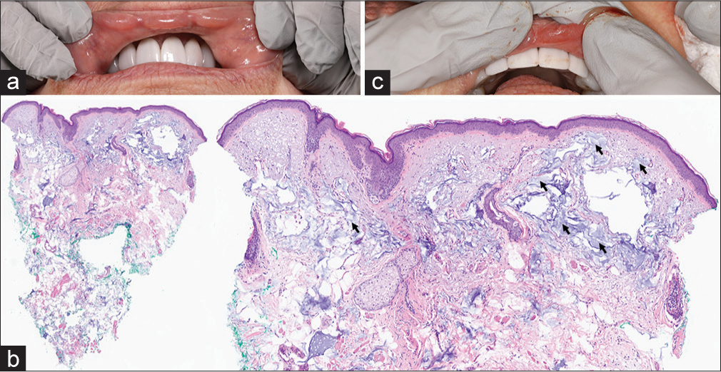 Persistent lip nodules after hyaluronic acid filler injection