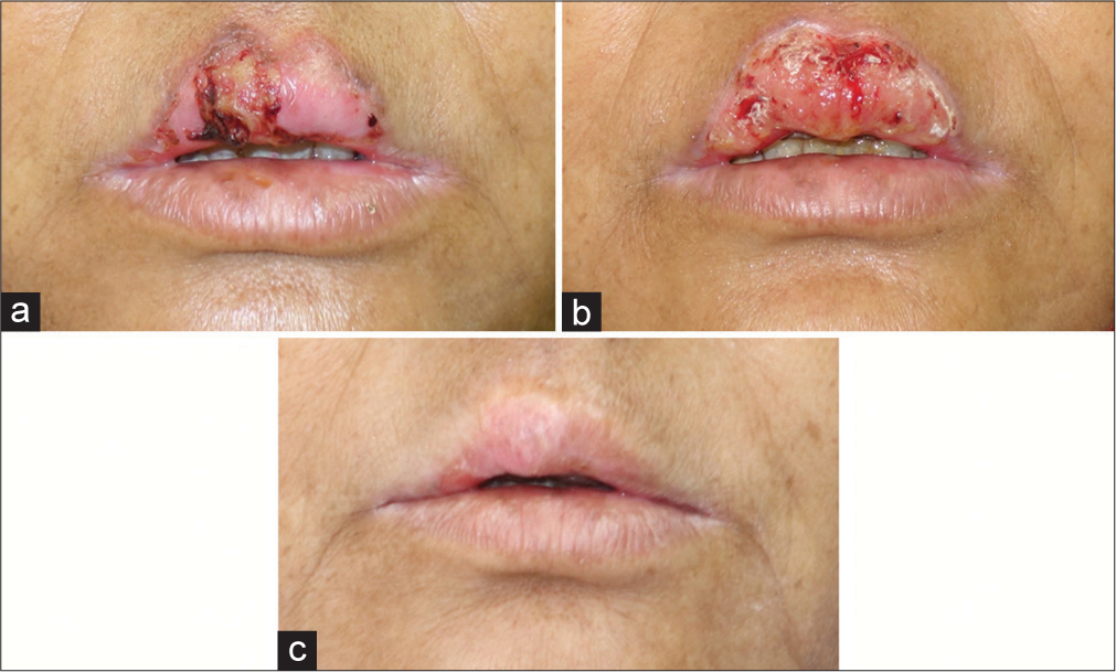 A rare presentation of labial porokeratosis: An innovative approach yielding exceptional esthetic results