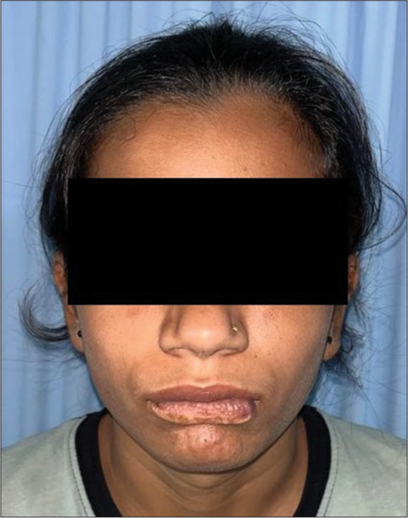 Post sclerotherapy lower lip reconstruction with dermo fat graft and labial advancement flap