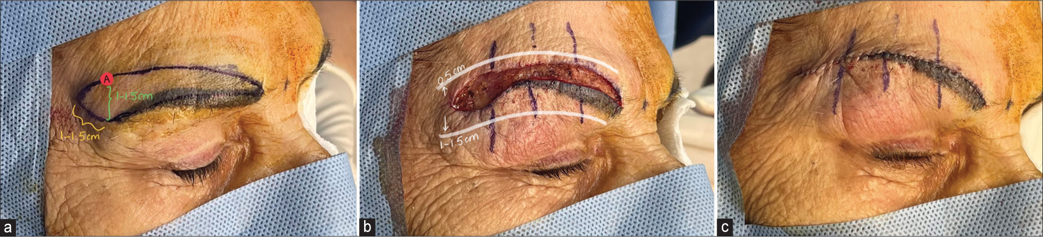 A supraciliary subcutaneous browlift for tattooed eyebrow ptosis