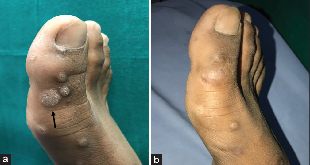 Intralesional immunotherapy of cutaneous warts using tuberculin purified protein derivative and vitamin D3 – A randomized comparative study