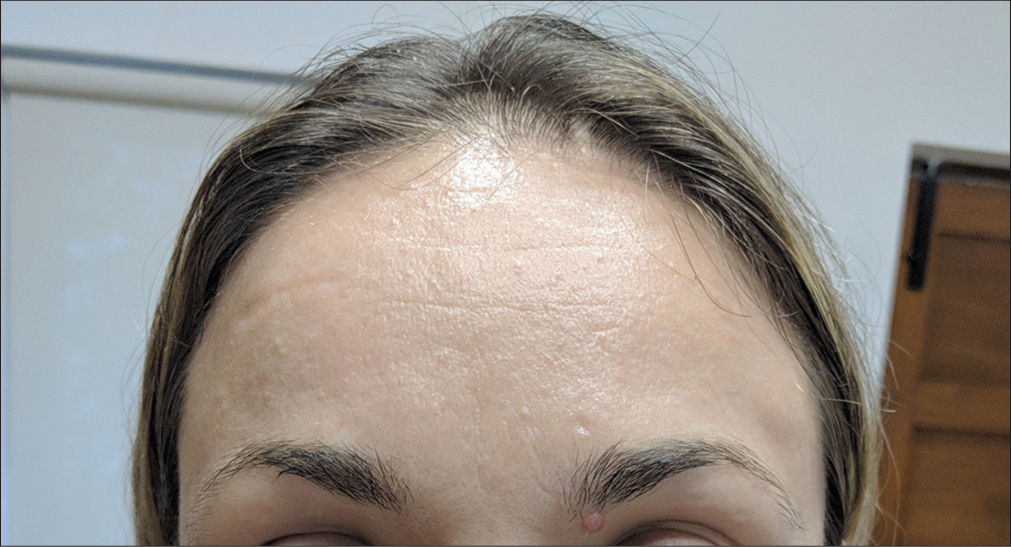 Delayed vascular occlusion following hyaluronic acid-based skin booster – A rare case report