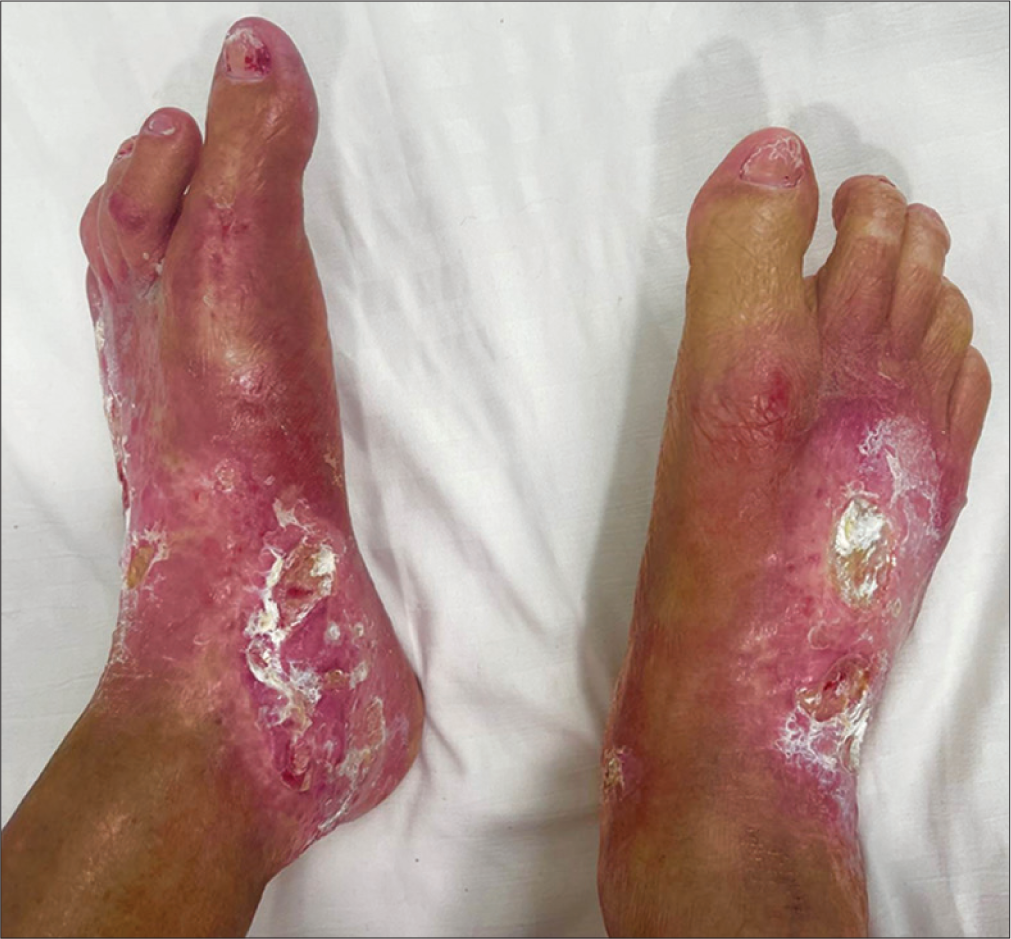 Successful treatment of ulcers of bullous morphea with platelet-rich fibrin therapy