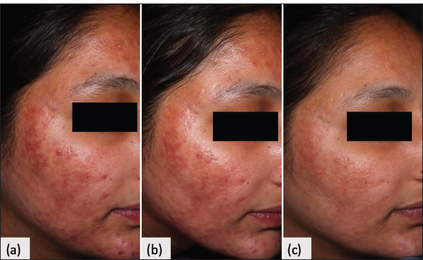 Efficacy and safety of nanofractional radiofrequency in treatment of atrophic acne scars: A retrospective analysis of 5 years