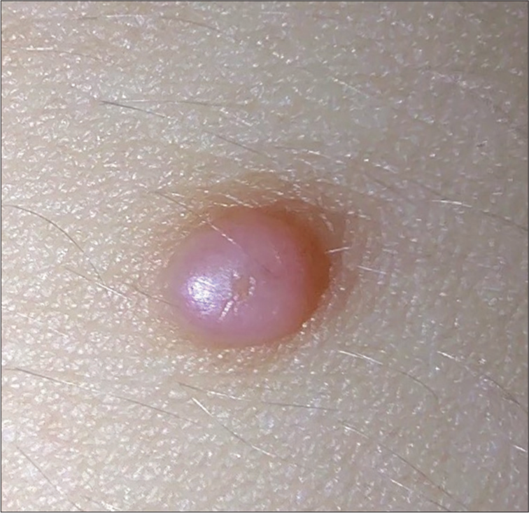 Confirmation of molluscum contagiosum diagnosis: Harnessing innovative testing techniques