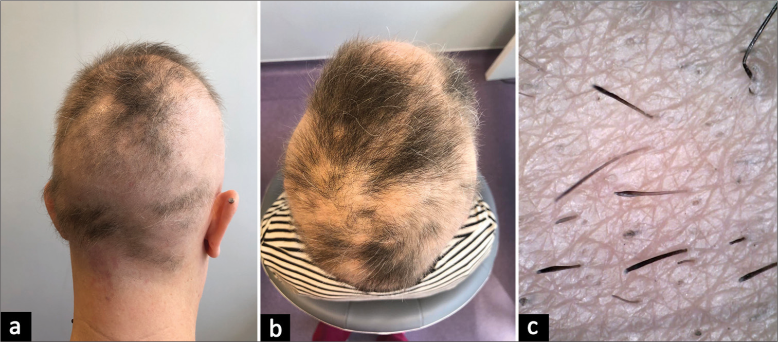 Platelet-rich plasma and topical minoxidil 5% in the treatment of severe alopecia areata: Report of two cases